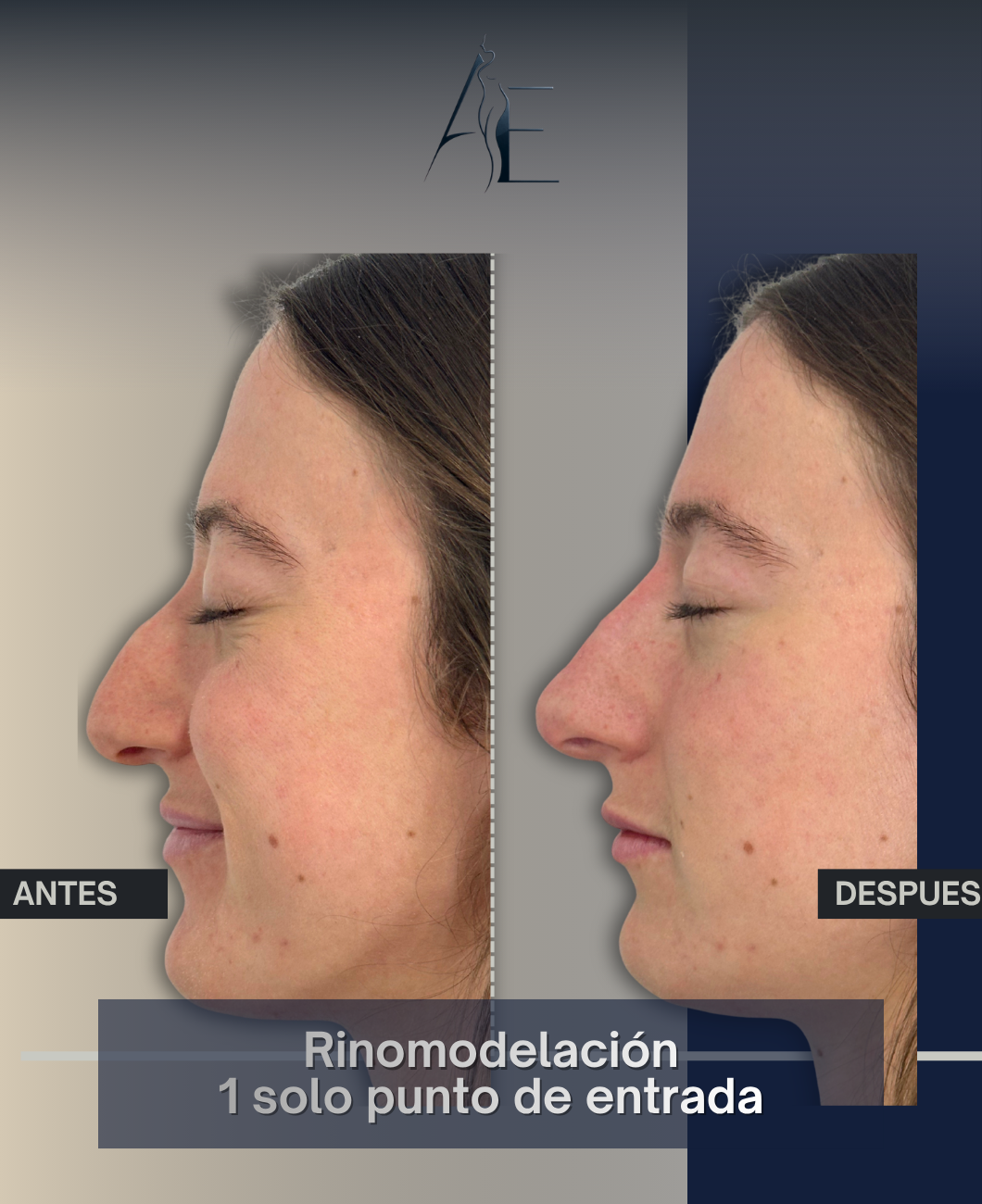 Antes y después de Rinomodelación Punto Único del Dr. Higuerey - Caso 3