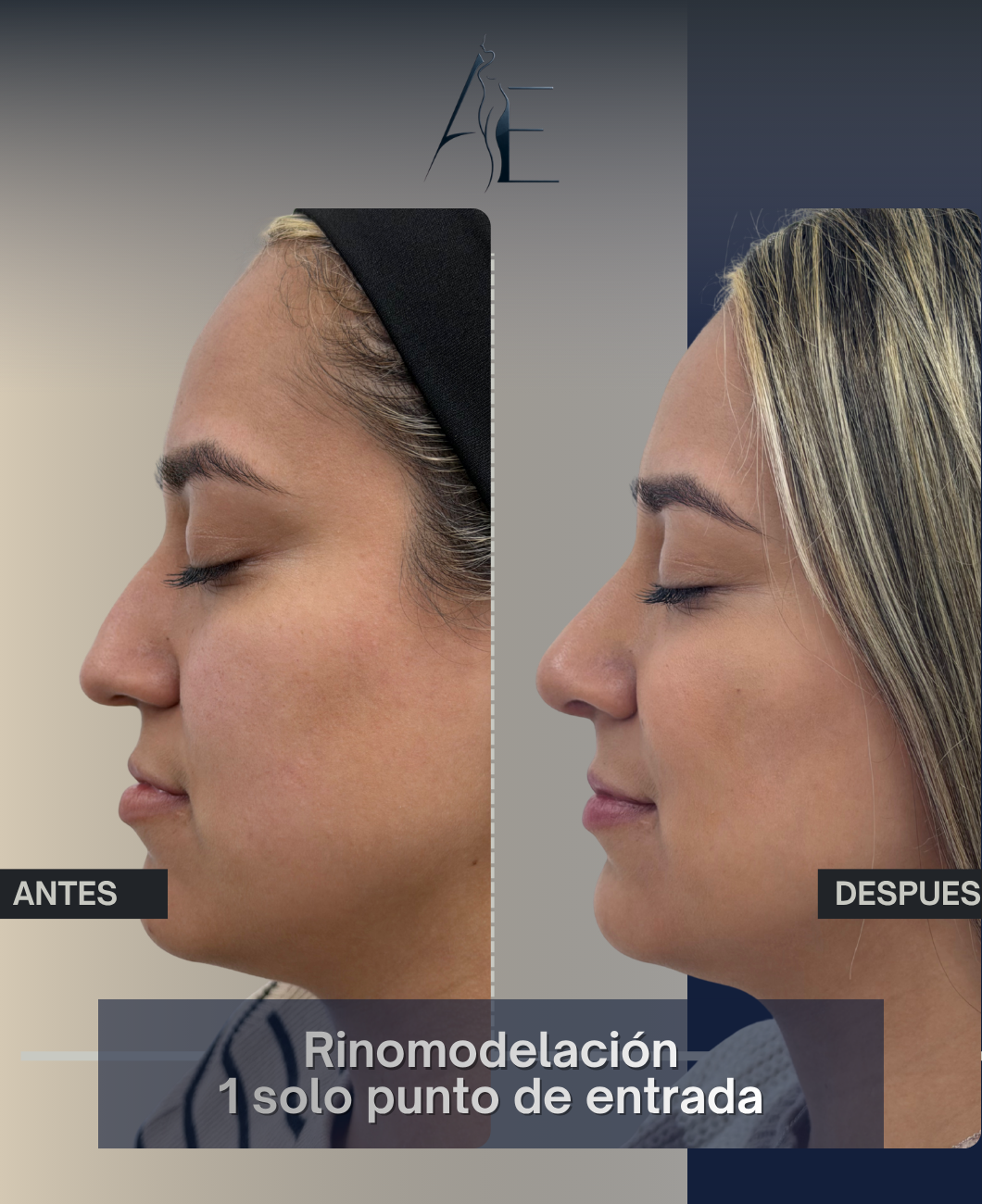 Antes y después de Rinomodelación Punto Único del Dr. Higuerey - Caso 1