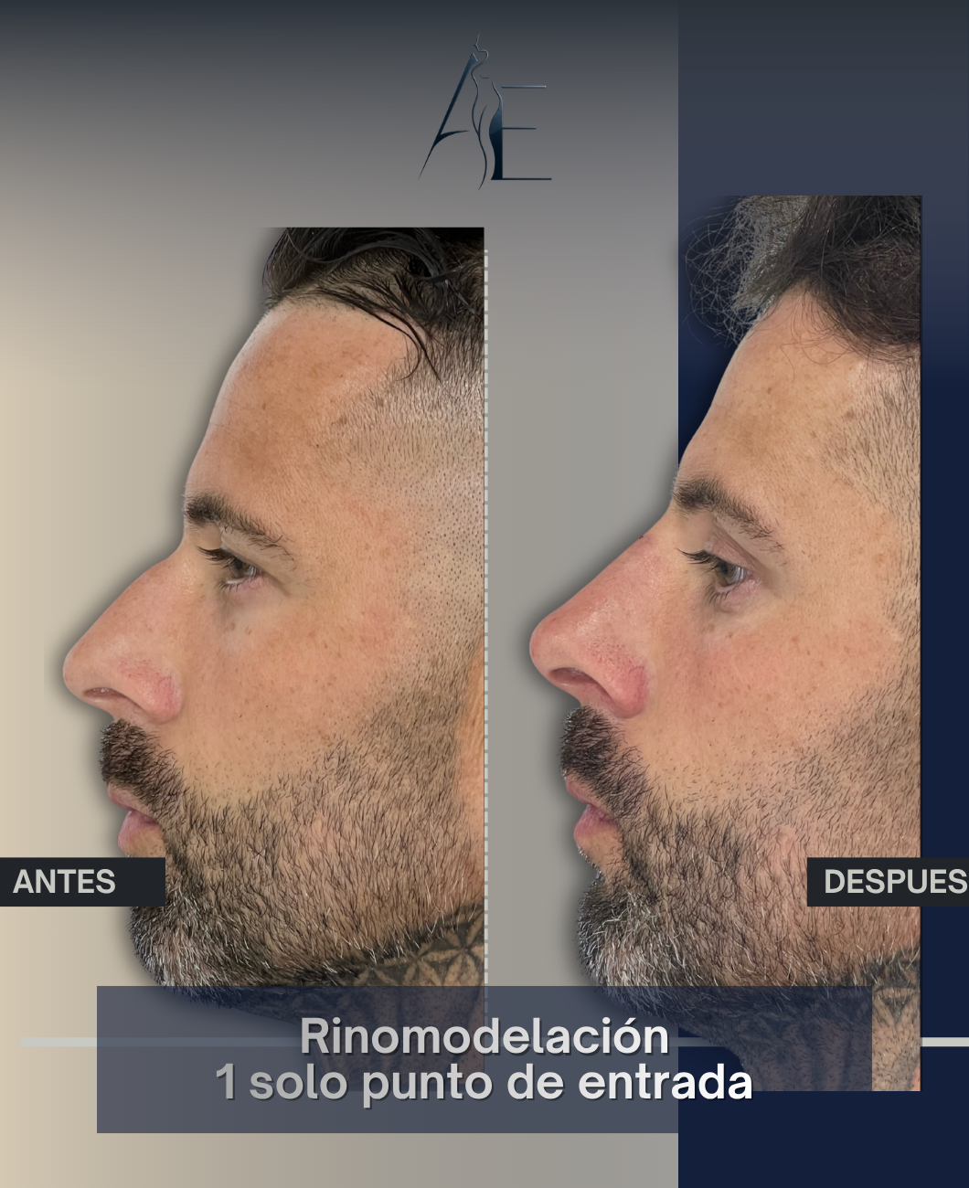 Antes y después de Rinomodelación Punto Único del Dr. Higuerey - Caso 2