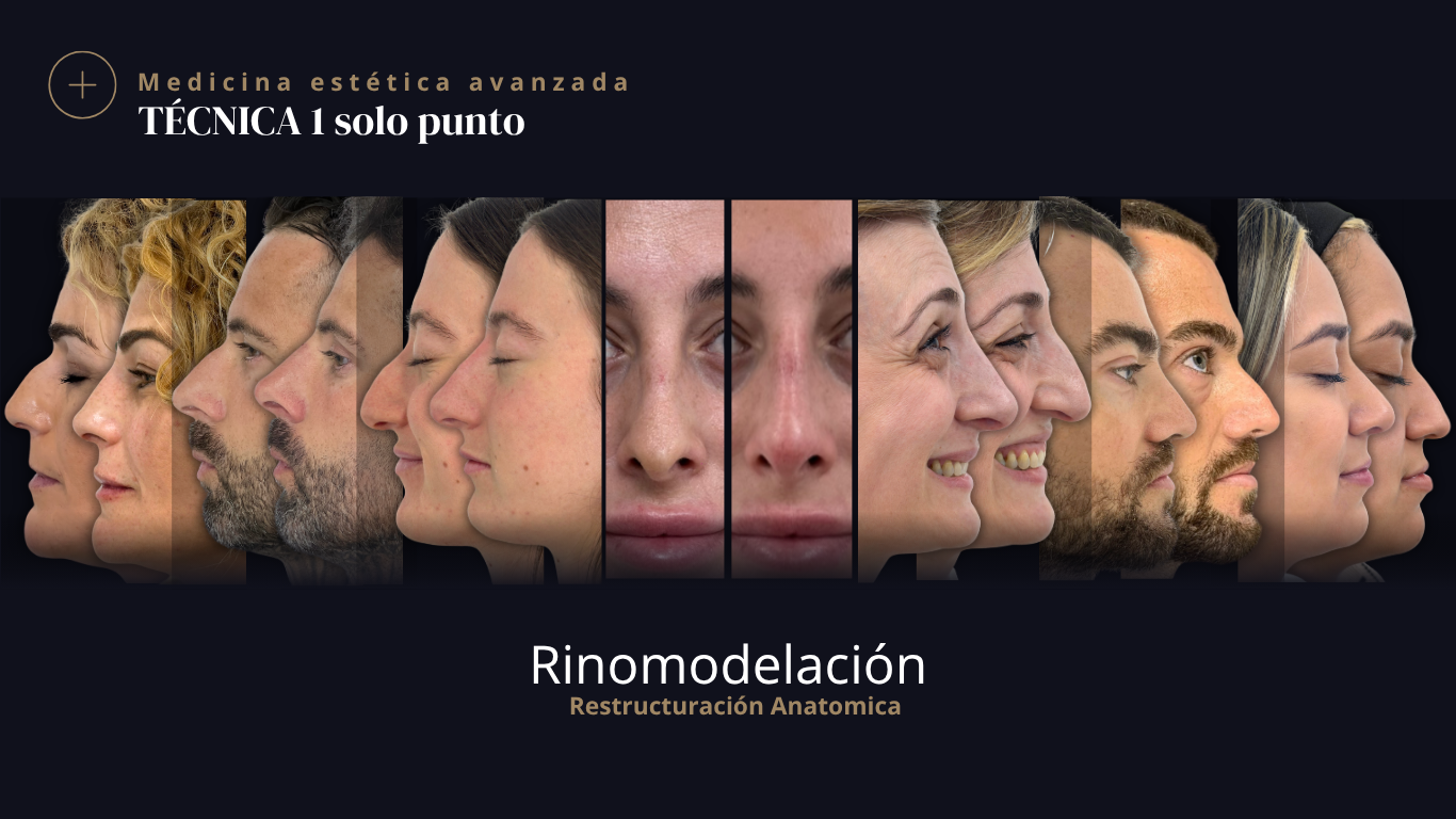 Rinomodelación Punto Único